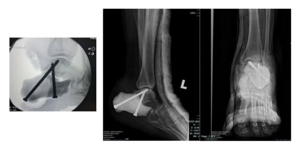 X-ray slides of the replacement heel bone.