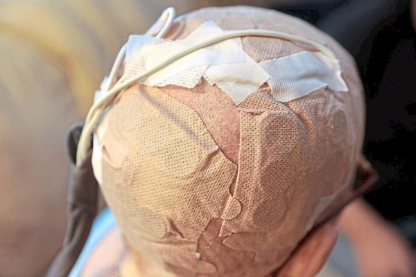 Oxenberg uses a portable wearable device called Optune Gio to treat her type of brain cancer. On her head are four arrays of nine ceramic discs that help deliver the TTF therapy. — Photos: TNS