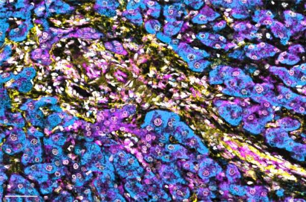 Biomarker may predict immunotherapy respo<em></em>nse in liver cancer