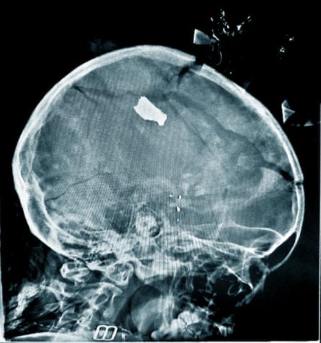 X-ray of piece of shrapnel in a child’s brain