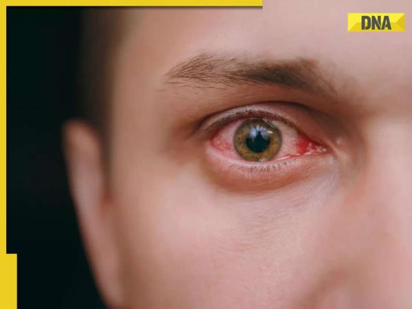 致命的出血眼病毒引发全球恐惧：检查其症状，原因，预防措施